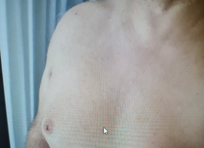 drsd